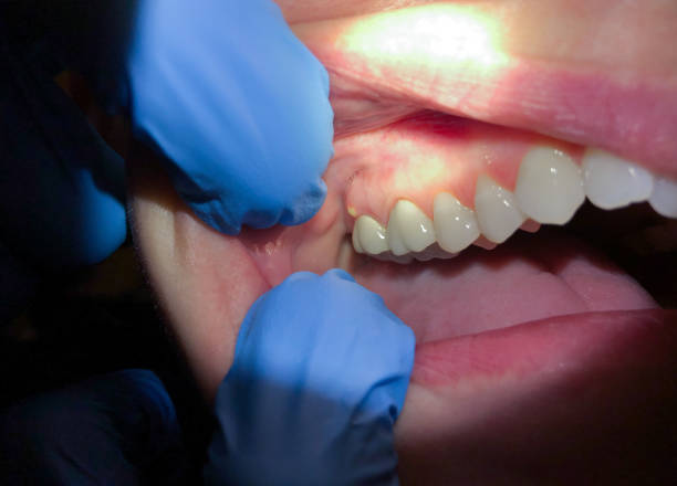 Best Broken or Chipped Tooth Repair in Union Gap, WA